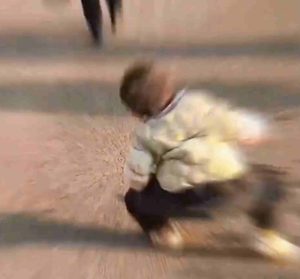 Китайска майка споделя възстановяването на малко дете от недоразвита тазобедрена става, получава онлайн подкрепа